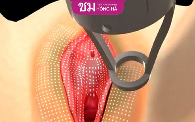 Phương pháp laser chỉ phù hợp với người trẻ tuổi chưa có ý định sinh nở trong thời gian sắp tới