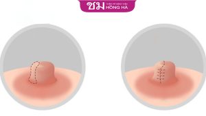 Thu nhỏ đầu vú có đau không? Những tác dụng phụ có thể xảy ra