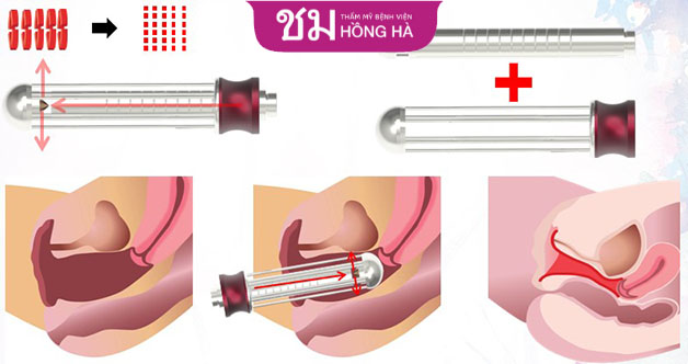 Tia laser sẽ tác động đến bề mặt niêm mạc làm săn chắc, se khít và hồng hào cô bé