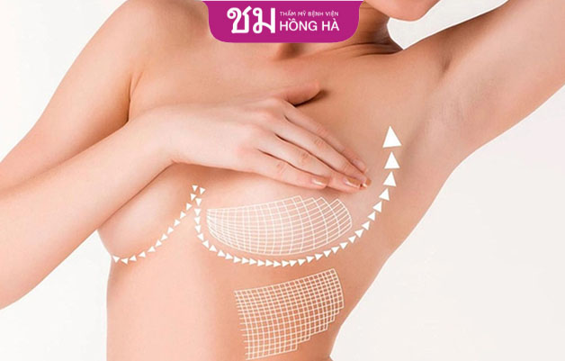 Treo ngực sa trễ hoàn toàn không ảnh hưởng đến sức khỏe