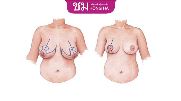 Treo sa trễ là đại phẫu phức tạp nên cần cẩn thận khi chọn lựa địa chỉ thẩm mỹ