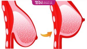 Treo ngực sa trễ có ảnh hưởng gì không? Cách hạn chế rủi do