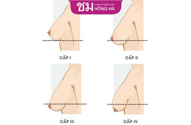 Với 4 cấp độ sa trễ ngực sẽ có kỹ thuật phẫu thuật khác nhau