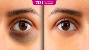 Nguyên nhân khiến mắt bị quầng thâm? Cách xóa quầng thâm mắt
