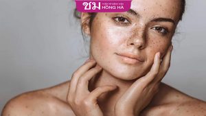 Bớt hori là gì? Phân biệt bớt hori với nám và bớt ota