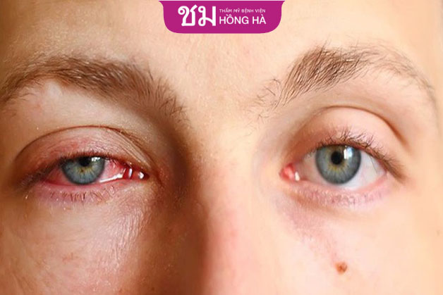 Dị ứng không chỉ khiến mắt sưng mà còn giật nhiều lần