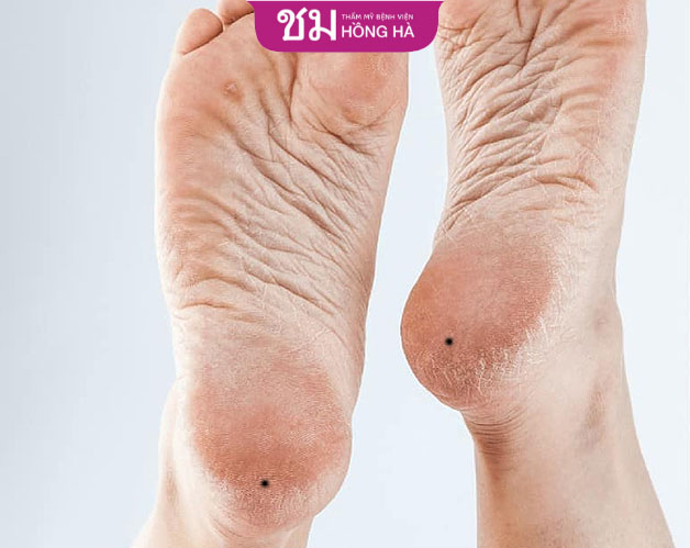 Nốt ruồi ở gót chân cho thấy người phụ nữ bao dung