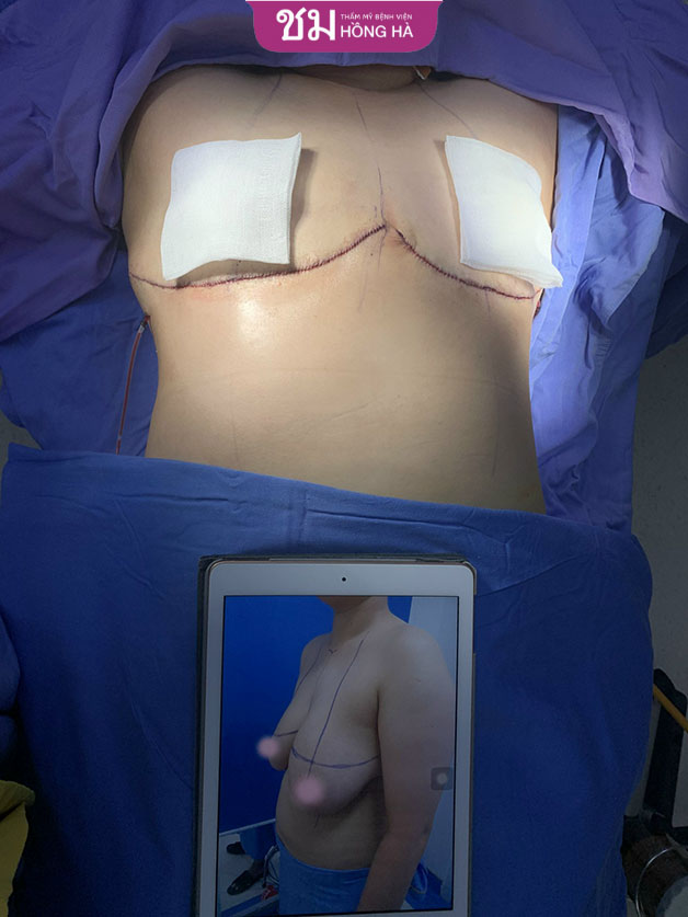 Kỹ thuật cắt ngực Double Incision
