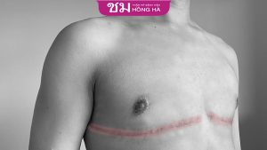 Phẫu thuật cắt ngực Transguy và những điều bạn cần biết
