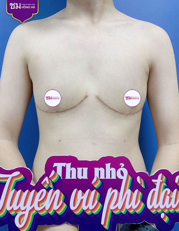 Với phương pháp Teat - Fold sẽ thích hợp cho những ai có vòng 1 không quá lớn