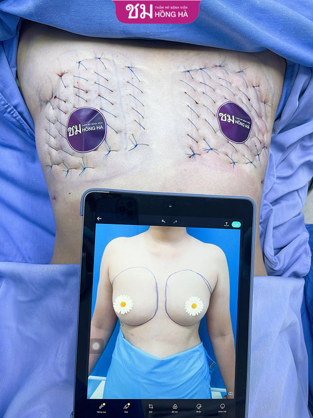 Keyhole Hemostatic Net là phương pháp cắt ngực hiện đại nhất hiện nay