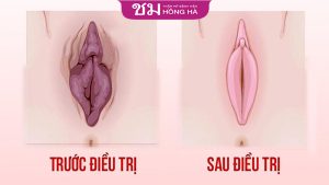 Tại sao cần thẩm mỹ cô bé? phương pháp tạo hình “cô bé” phổ biến