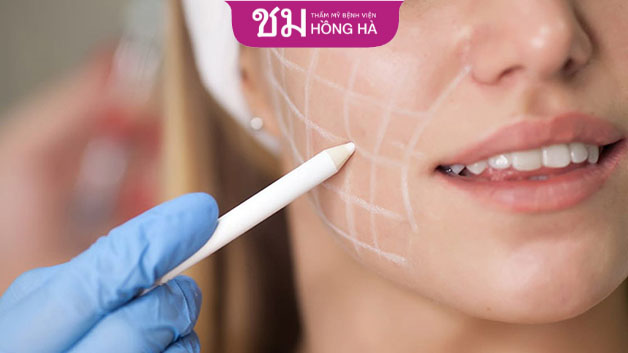 Sau khi hút mỡ má, gương mặt không còn bầu bĩnh mà trẻ trung hơn