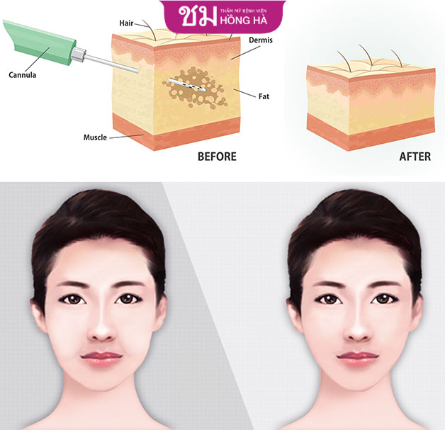 Với công nghệ hiện đại, hút mỡ vùng má không chỉ loại bỏ hết mỡ thừa mà còn giúp da thêm săn chắc