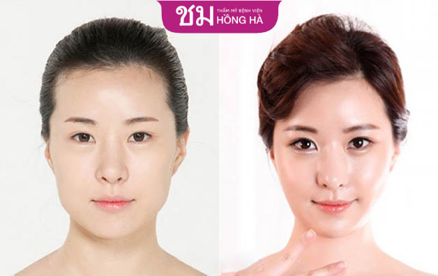 Mỡ má biến mất, gương mặt thon gọn không còn bầu bĩnh như trước