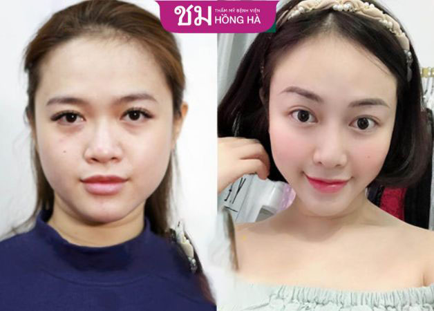Gương mặt của khách hàng trẻ trung hơn nhiều sau 1 lần giảm mỡ má