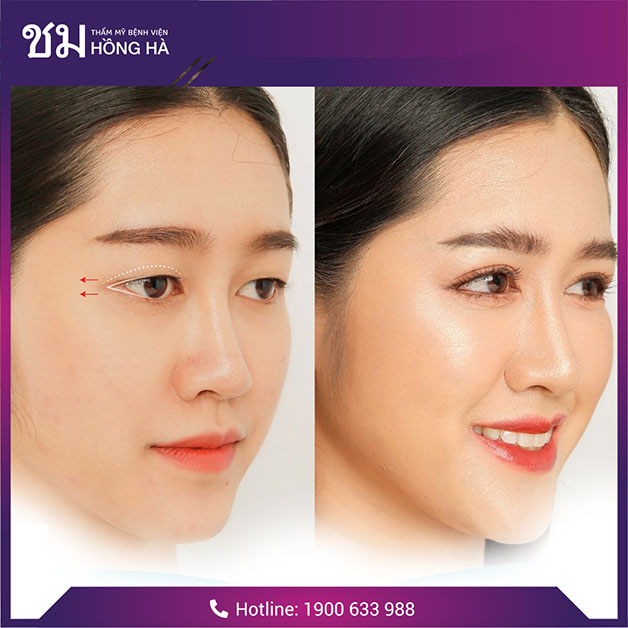 Công nghệ Thai Eyelid giúp vết thương nhanh lành gấp 3 lần phương pháp thông thường