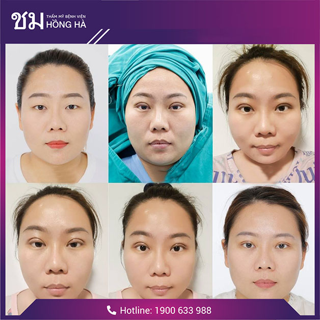Hình ảnh khách hàng sau khi thực hiện thẩm mỹ mắt tại Hồng Hà