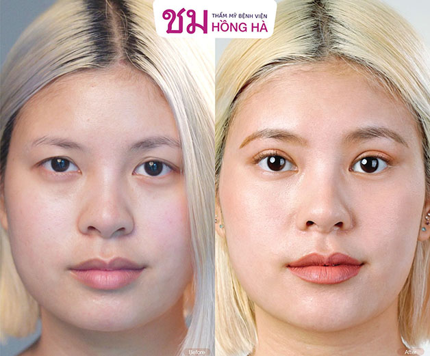Có thể nhận thấy sự khác biệt rõ ràng, tình trạng sụp mí được khắc phục hoàn toàn