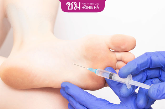 Phương pháp tiêm botox vào lòng bàn chân chỉ mang đến hiệu quả tạm thời