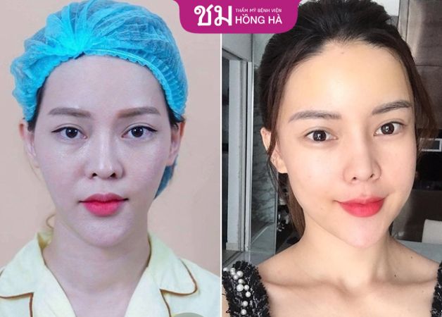 Khuôn mặt sau cấy mỡ đầy đặn, không còn hốc hác