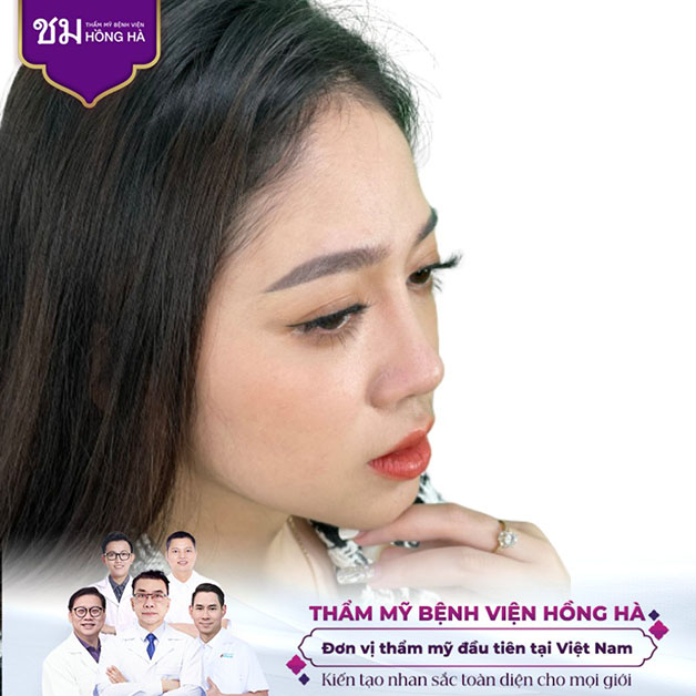 Tình trạng mũi của khách hàng sau khi sửa tại Hồng Hà vô cùng tự nhiên
