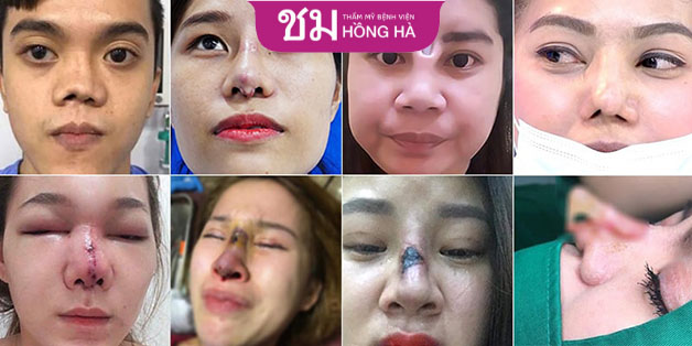 Một số biến chứng nặng nề sau khi nâng mũi