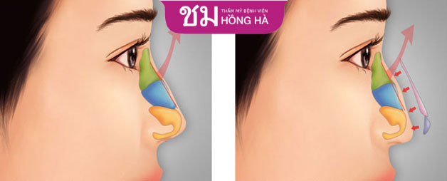 Phẫu thuật chỉnh sửa sống mũi gồ sẽ tái tạo lại cấu trúc mũi