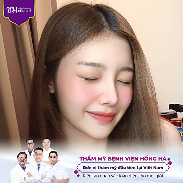 Hình ảnh khách hàng sau khi sửa mũi gồ tại Hồng Hà