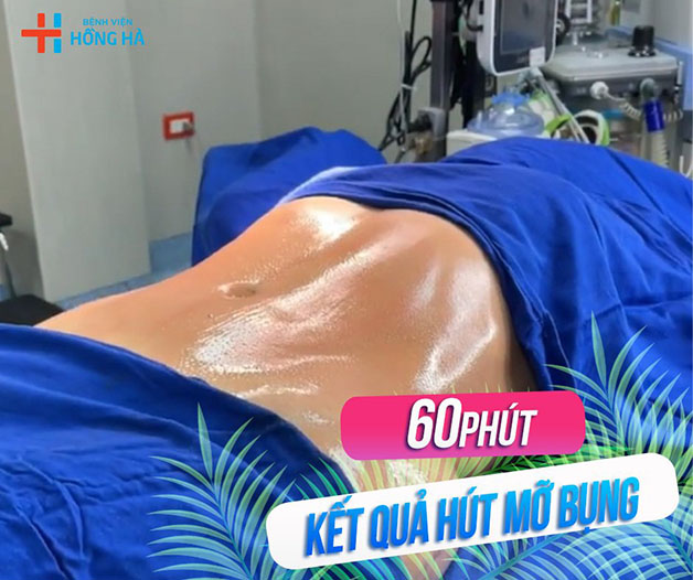 Kết quả sau 60 phút hút mỡ tạ Thẩm mỹ Bệnh viện Hồng Hà