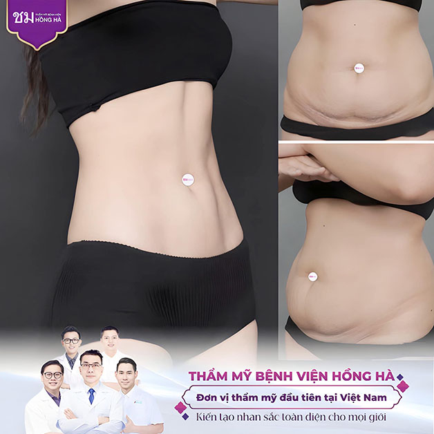 Lấy lại vòng eo con kiến nhanh chóng, không còn tình trạng chảy xệ