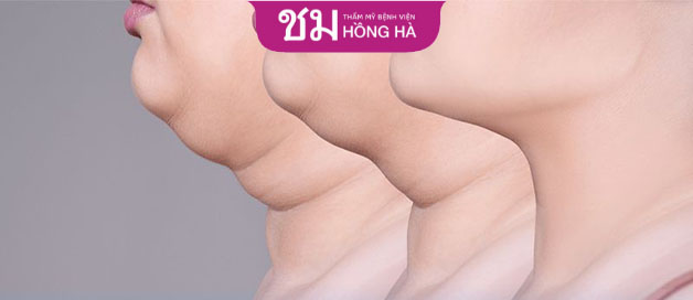 Sau khi hút mỡ sẽ không còn tình trạng hai cằm