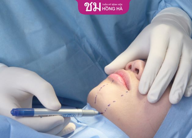 Trước khi bắt tay vào thực hiện, bác sĩ sẽ đo vẽ và tính toán lượng mỡ cần loại bỏ