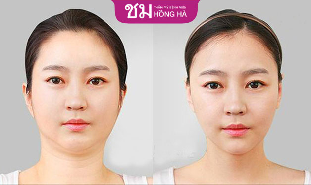 Mỡ nọng cằm hoàn toàn biến mất, trả lại gương mặt thon gọn