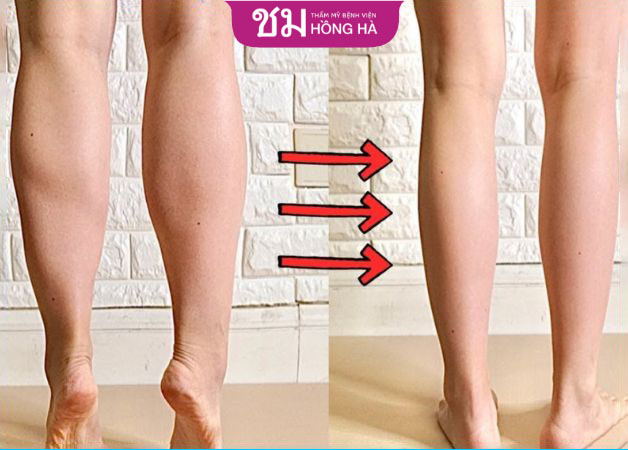 Dễ dàng nhận thấy sự cải thiện sau 1 liệu trình hút mỡ ở bắp chân