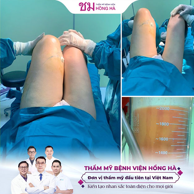 Công nghệ hút mỡ Thai Hi - Lipo được chuyển giao độc quyền tại Hồng Hà sẽ trả lại đôi chân thon gọn, nuột nà
