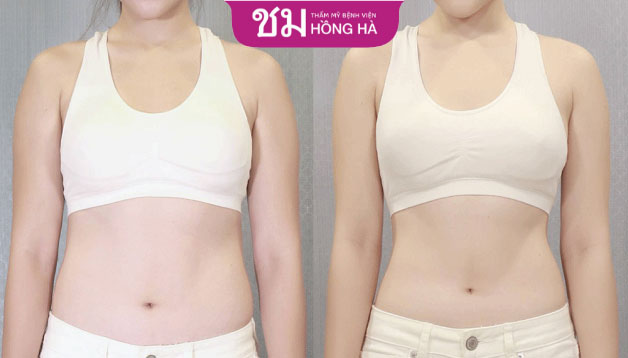 Eo gọn, dáng xinh của khách hàng sau 6 tháng hút mỡ