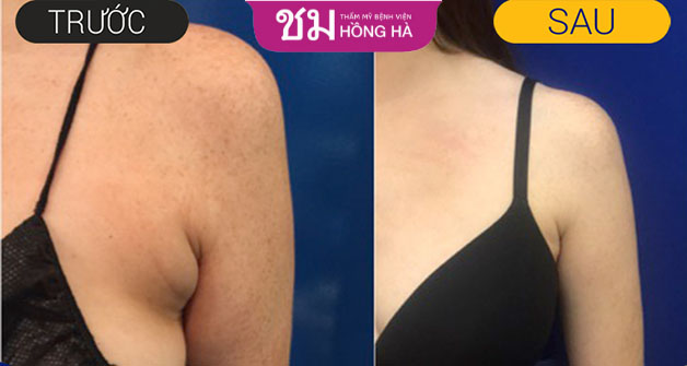 Công nghệ hiện đại tại Hồng Hà đảm bảo không để lại sẹo