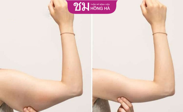Hút mỡ vùng cánh tay là phương pháp ít xâm lấn, không ảnh hưởng đến mô cơ