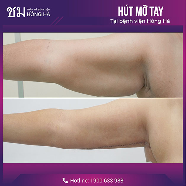 Mỡ thừa, da chùng không còn sau 1 lần thực hiện