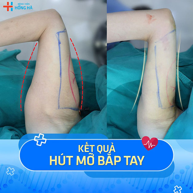 Hình ảnh khách hàng trước và sau khi thực hiện hút mỡ tại bắp tay