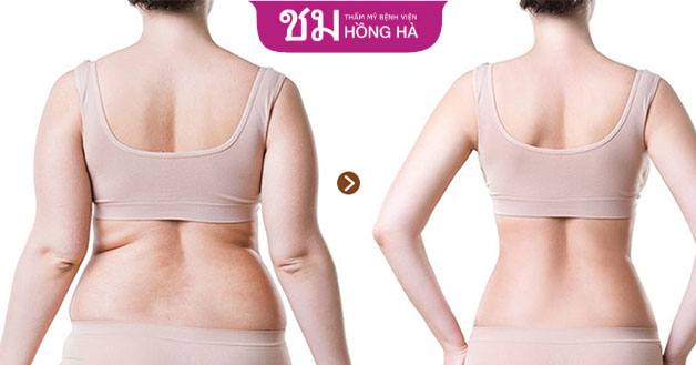 Hút mỡ lưng sẽ loại bỏ hoàn toàn mỡ thừa tích tụ ở lưng