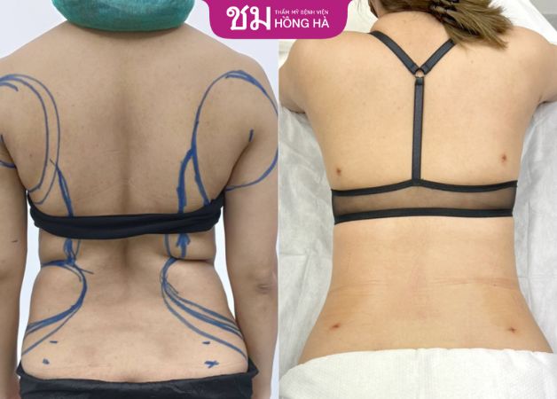 Có thể thấy rõ những ngấn mỡ ở lưng đều không còn