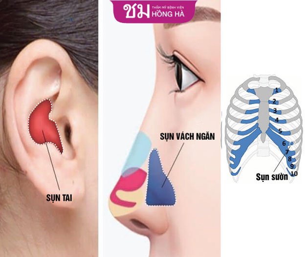 Sụn tự thân dùng để nâng mũi có 3 loại phổ biến