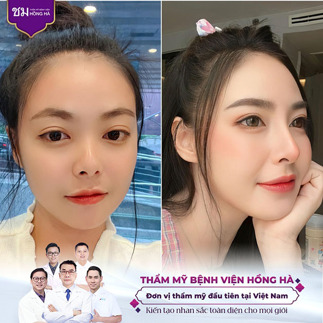 Hình ảnh khách hàng trước và sau khi thực hiện nâng mũi bằng sụn tự thân