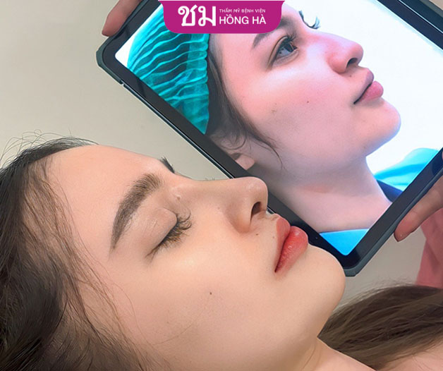 Hình ảnh khách hàng trước và sau khi nâng mũi tại Hồng Hà