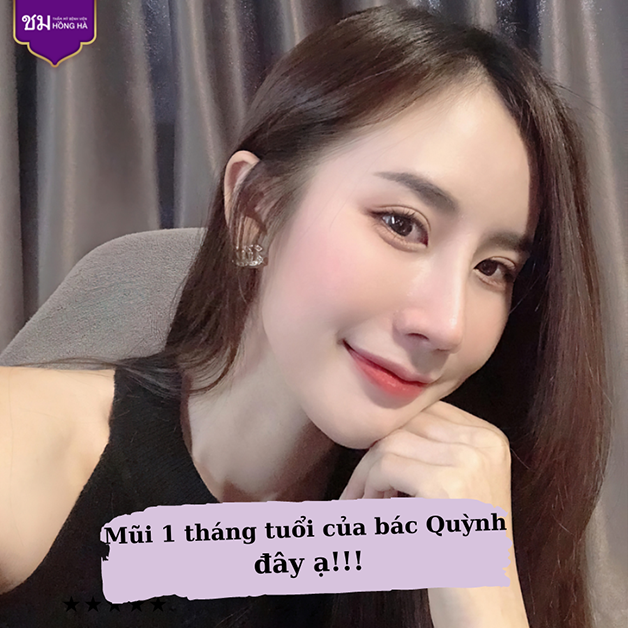 Dáng mũi ổn định sau 1 tháng nâng mũi