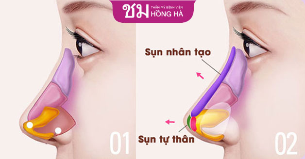 Nâng mũi bọc sụn được đánh giá cao về độ an toàn nên được nhiều người lựa chọn