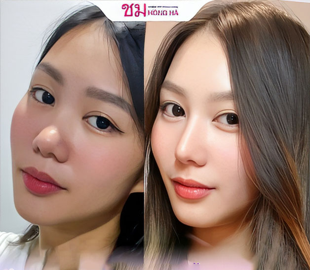Hình ảnh khách hàng nâng mũi cấu trúc Thai Shape tại Thẩm mỹ Bệnh viện Hồng Hà