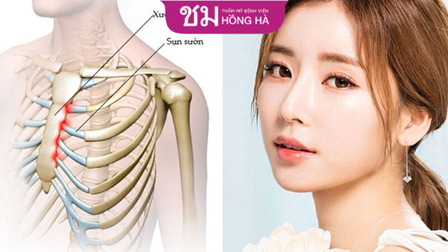 Sụn sườn có độ tương thích với cơ thể cao